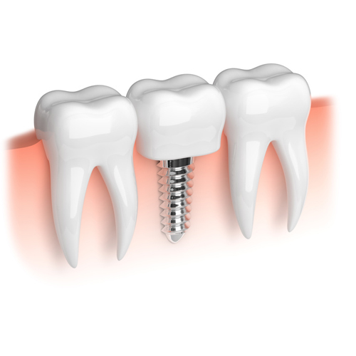 implante dental fijo