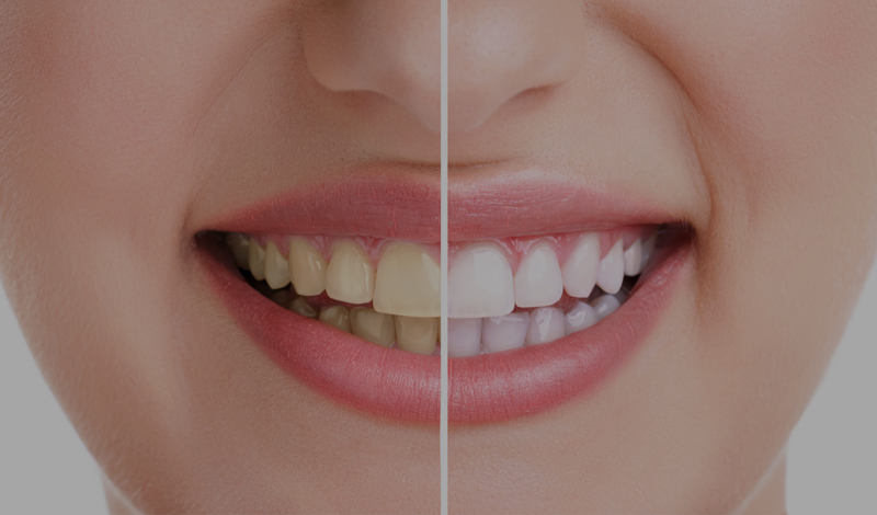 ¿Manchas en los dientes? 7 causas por las que aparecen