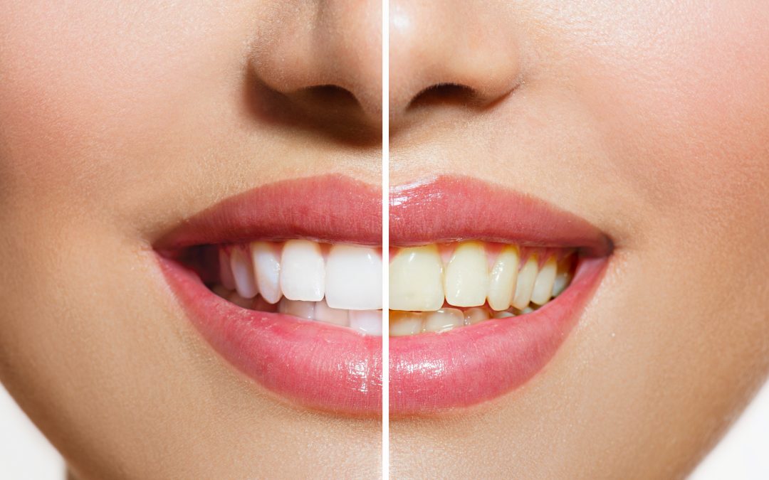 ¿Cómo son los dientes de un fumador? Tabaco y salud dental